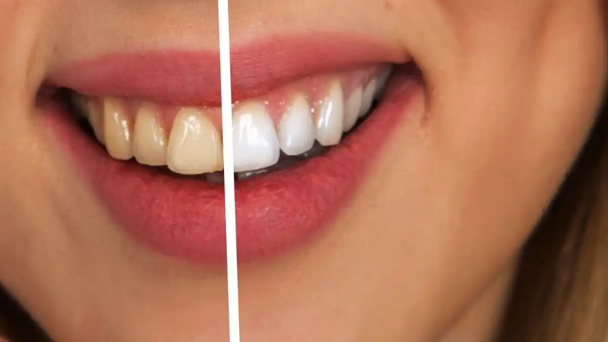teeth whitening